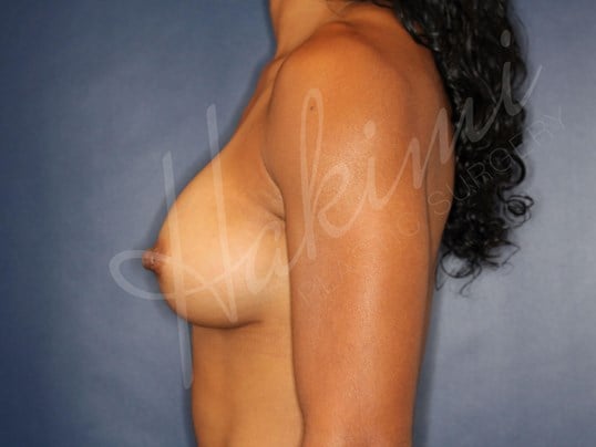 295 cc Silicone Implants After