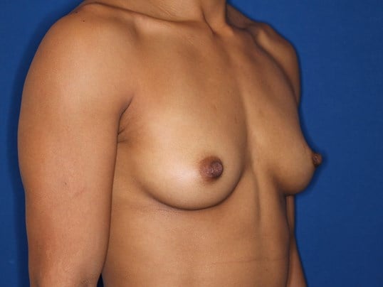 295 cc Silicone Implants Before