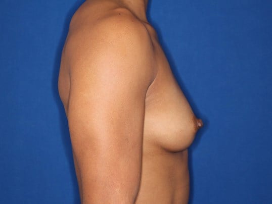 295 cc Silicone Implants Before