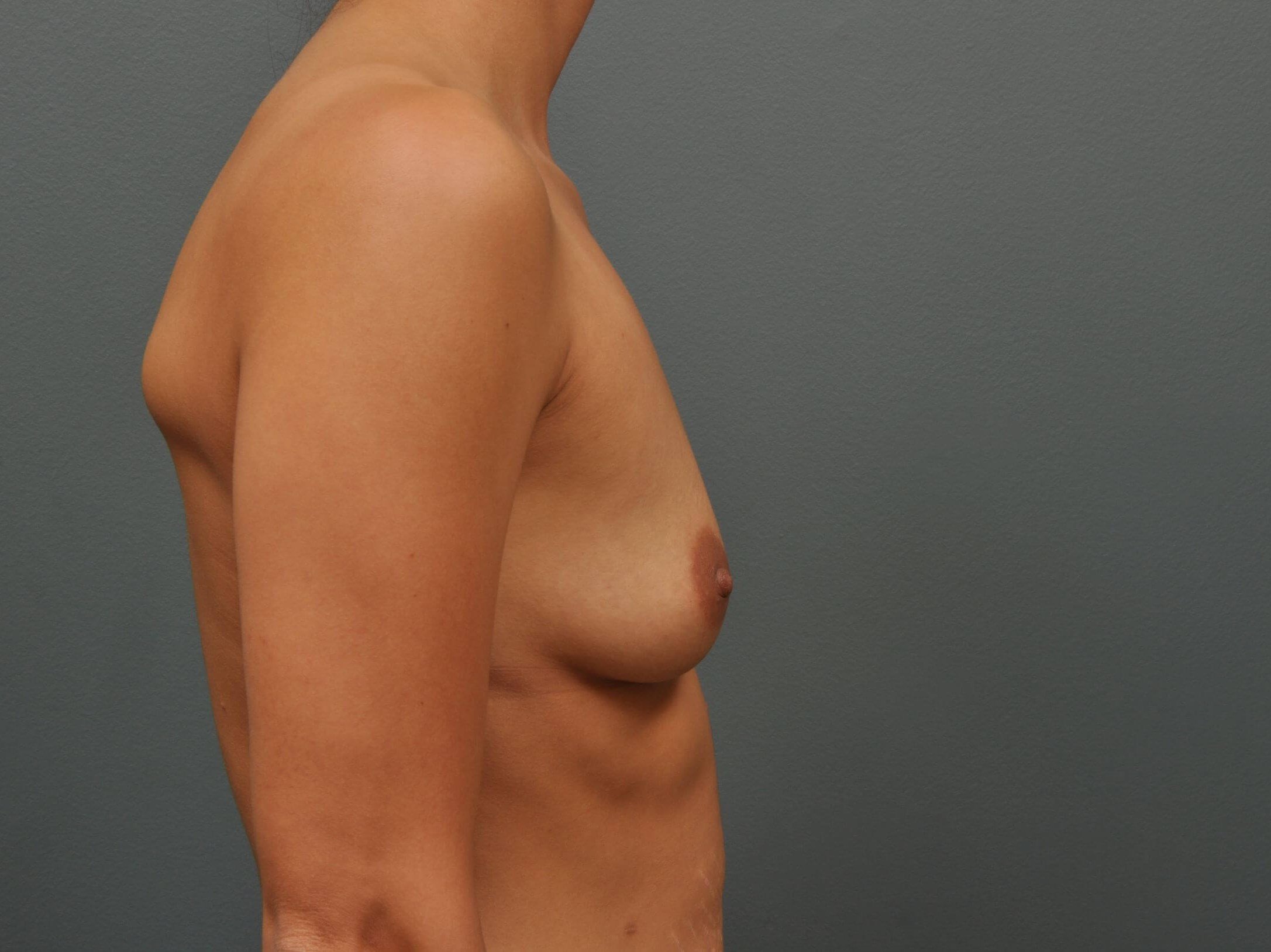 350 cc Silicone Implants Before