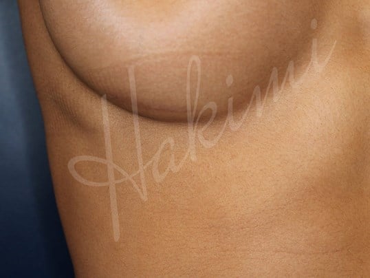 295 cc Silicone Implants Scar after 3 months