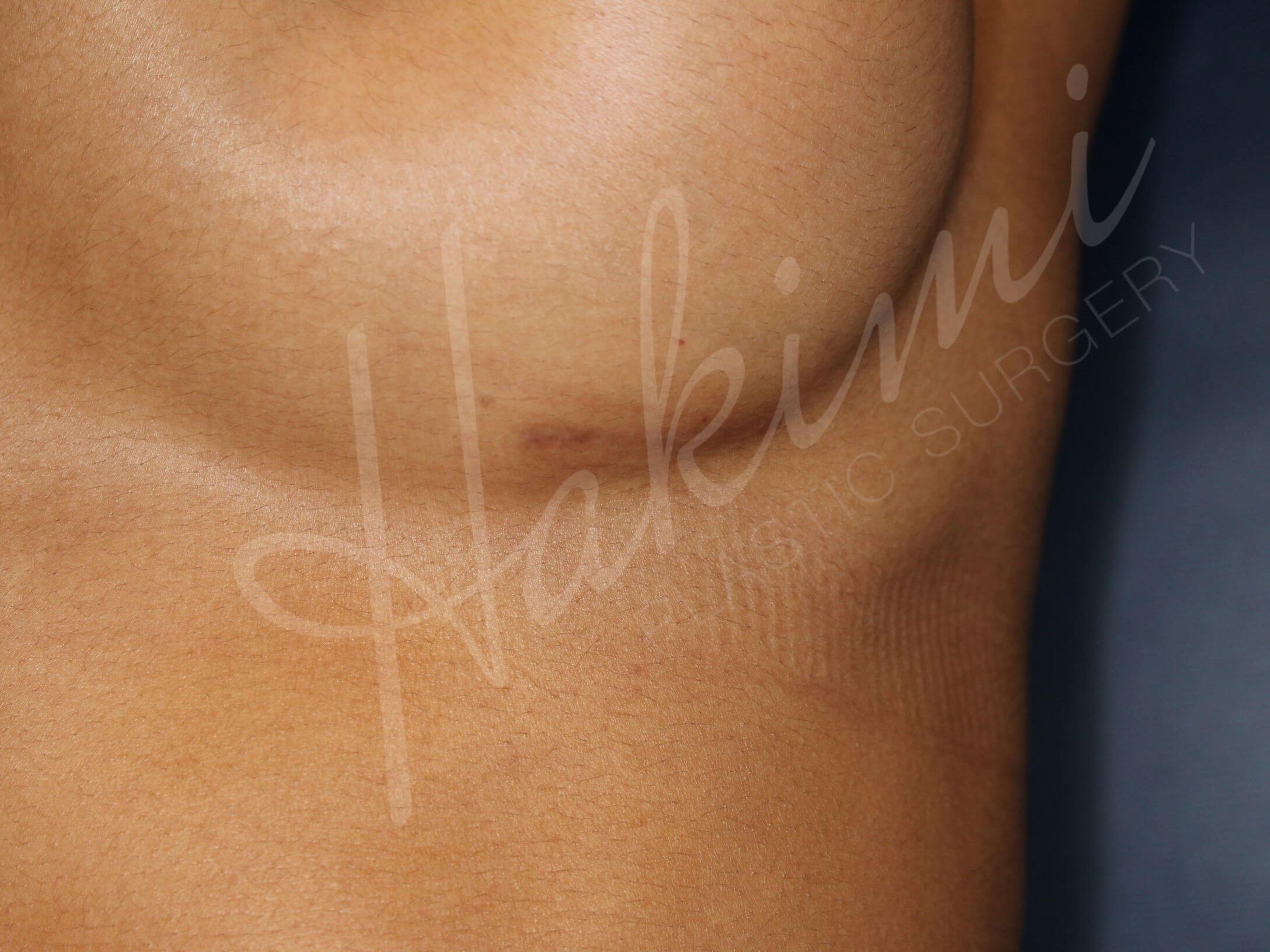 295 cc Silicone Implants Scar after 3 months