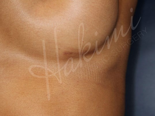 295 cc Silicone Implants Scar after 3 months