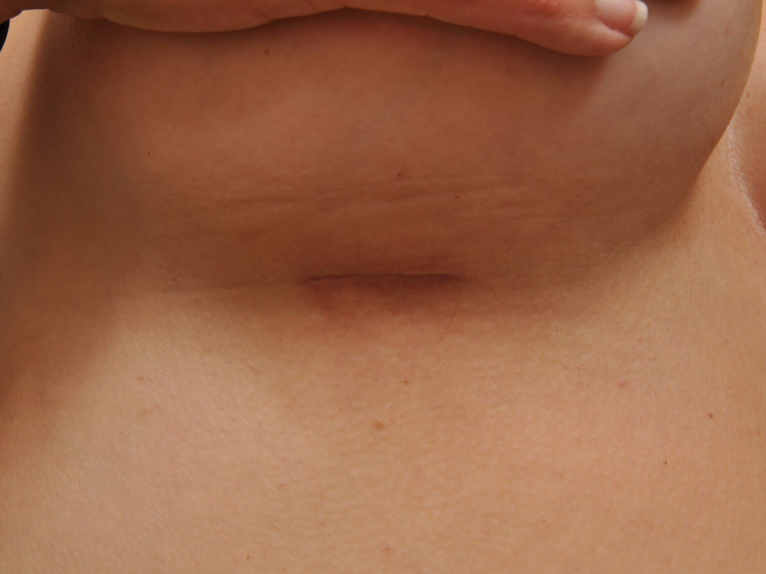 550 cc Silicone Implants 3 cm Scar