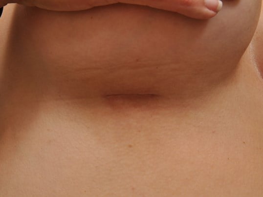 550 cc Silicone Implants 3 cm Scar