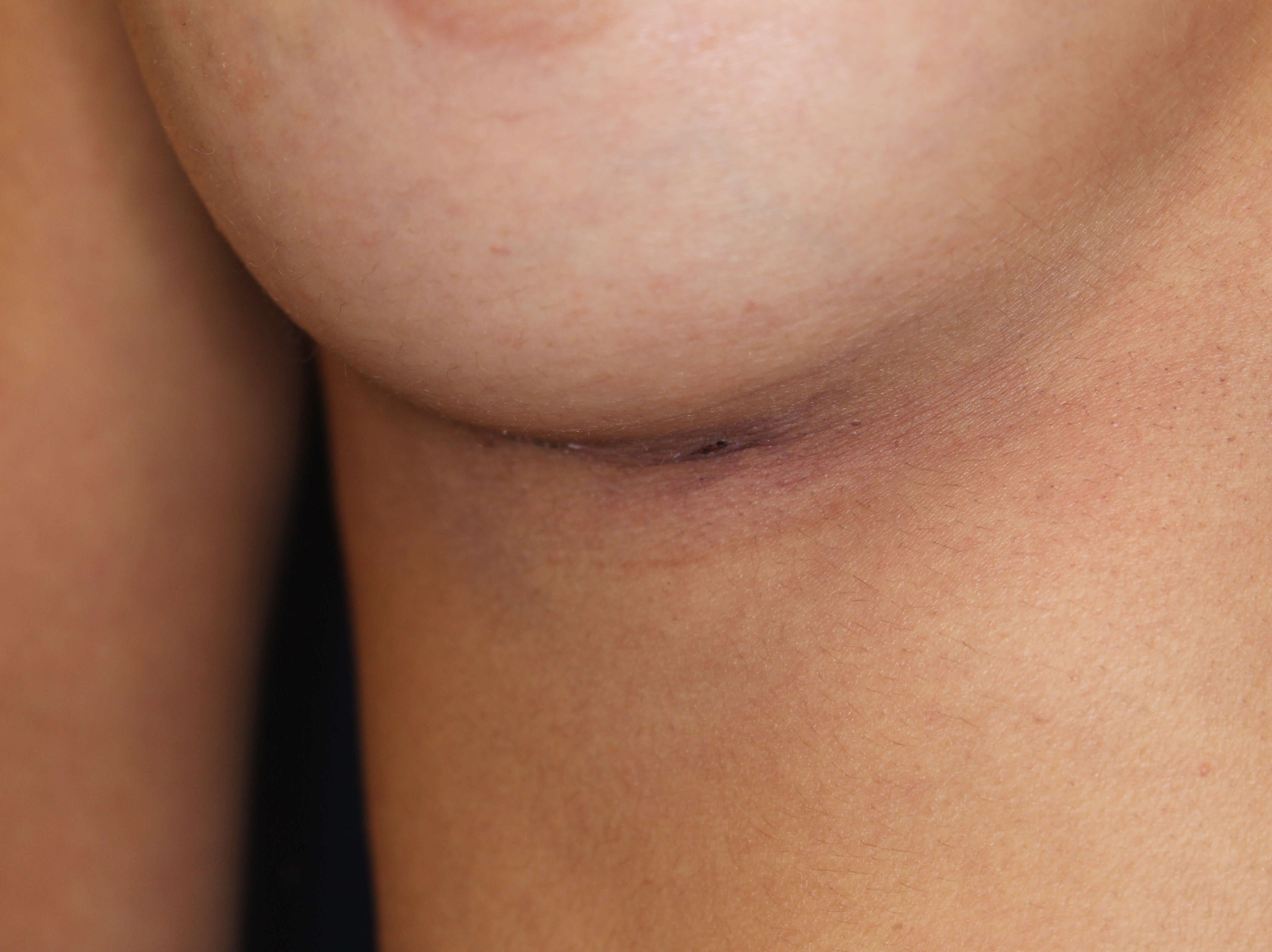 245 cc Silicone Implants, 3 cm Scar