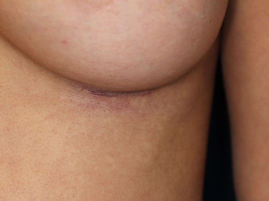 245 cc Silicone Implants, 3 cm Scar