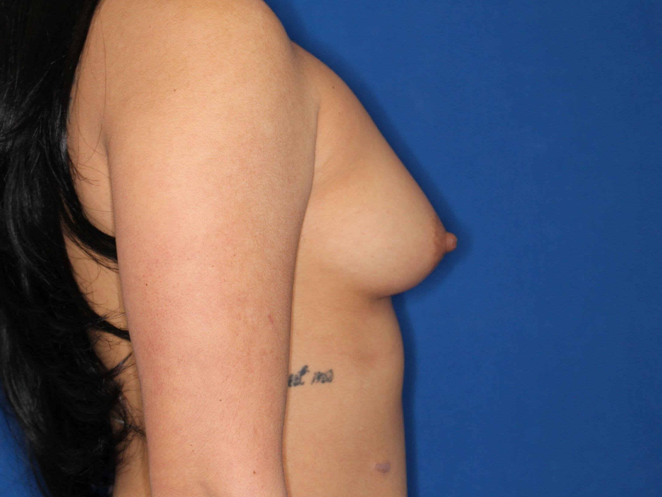 345 cc Silicone Implants Before