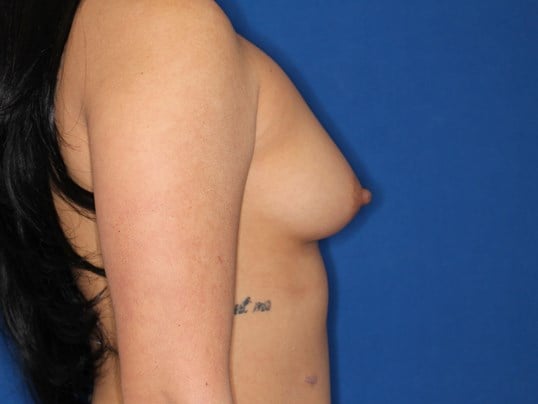 345 cc Silicone Implants Before