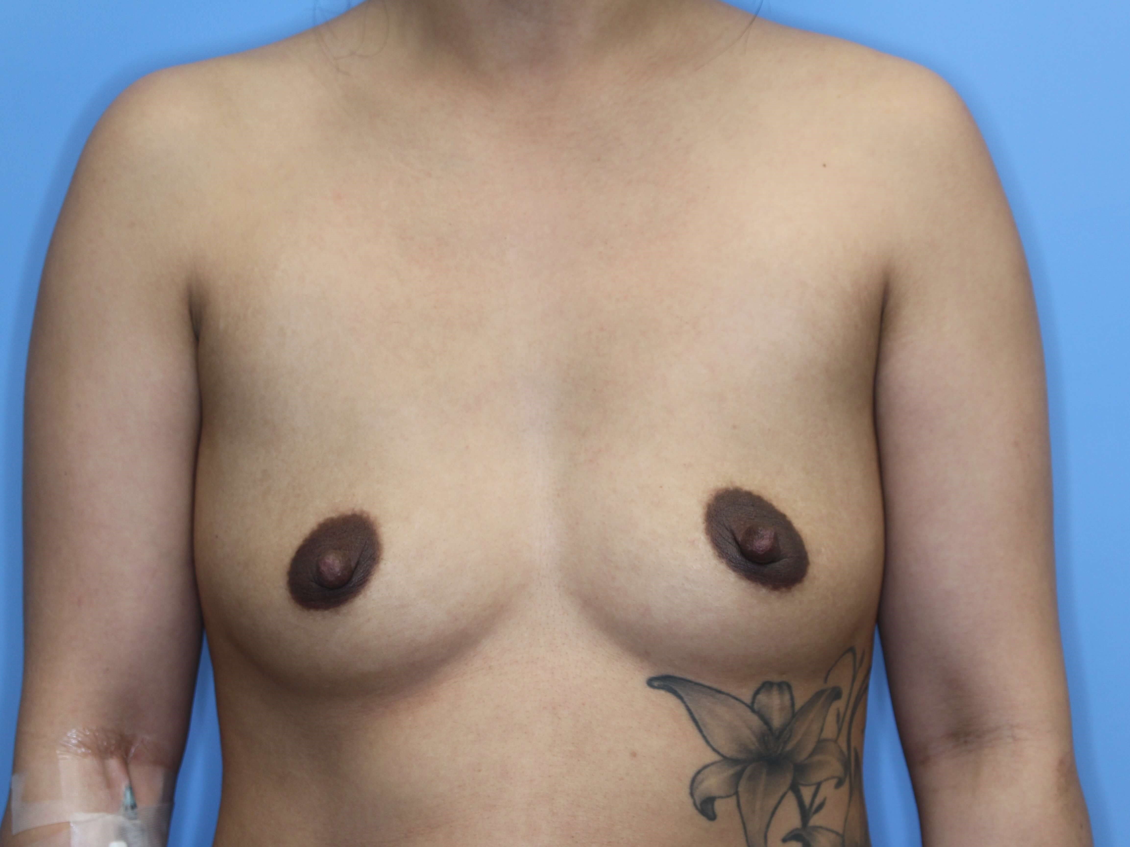 350 cc Silicone Implants Before