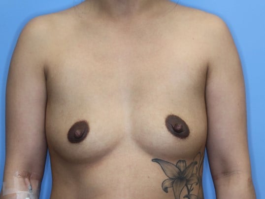 350 cc Silicone Implants Before