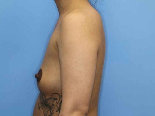 350 cc Silicone Implants Before