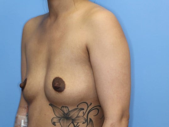 350 cc Silicone Implants Before