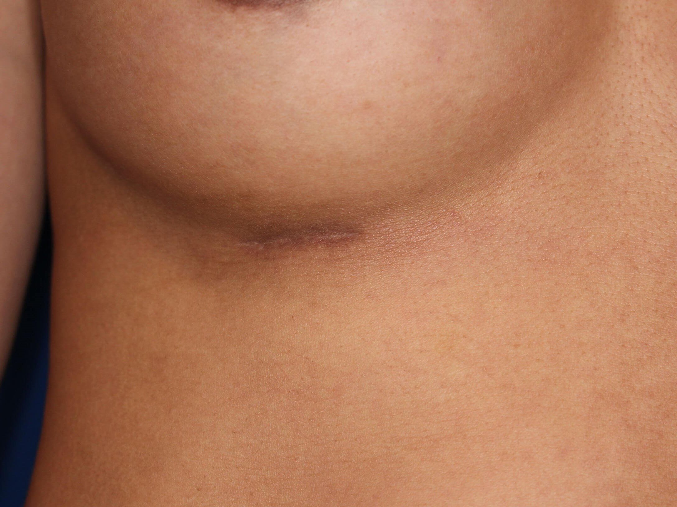 350 cc Silicone Implants 3 cm Scar