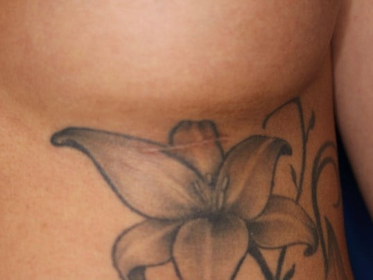 350 cc Silicone Implants 3 cm Scar