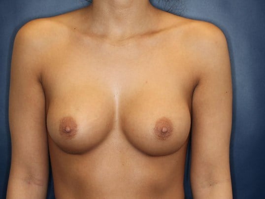 180 cc Silicone Implants After