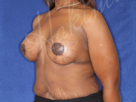 Breast Lift + Silicone Implant After