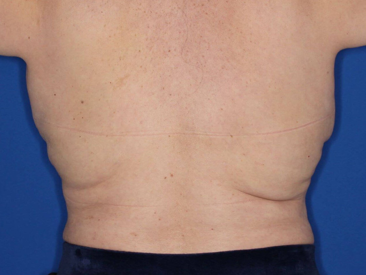 Awake Liposuction Bra Rolls Before