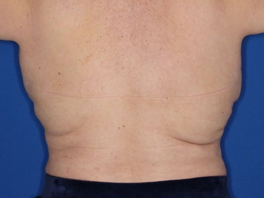 Awake Liposuction Bra Rolls Before