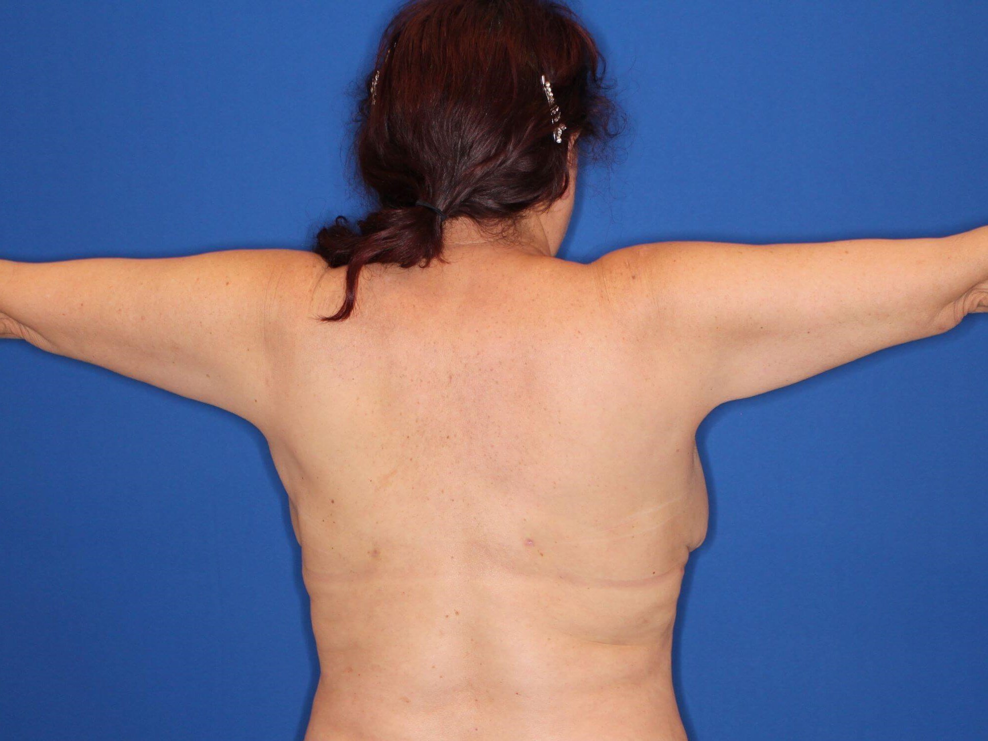 Liposuction of arms and back After