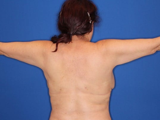 Liposuction of arms and back After