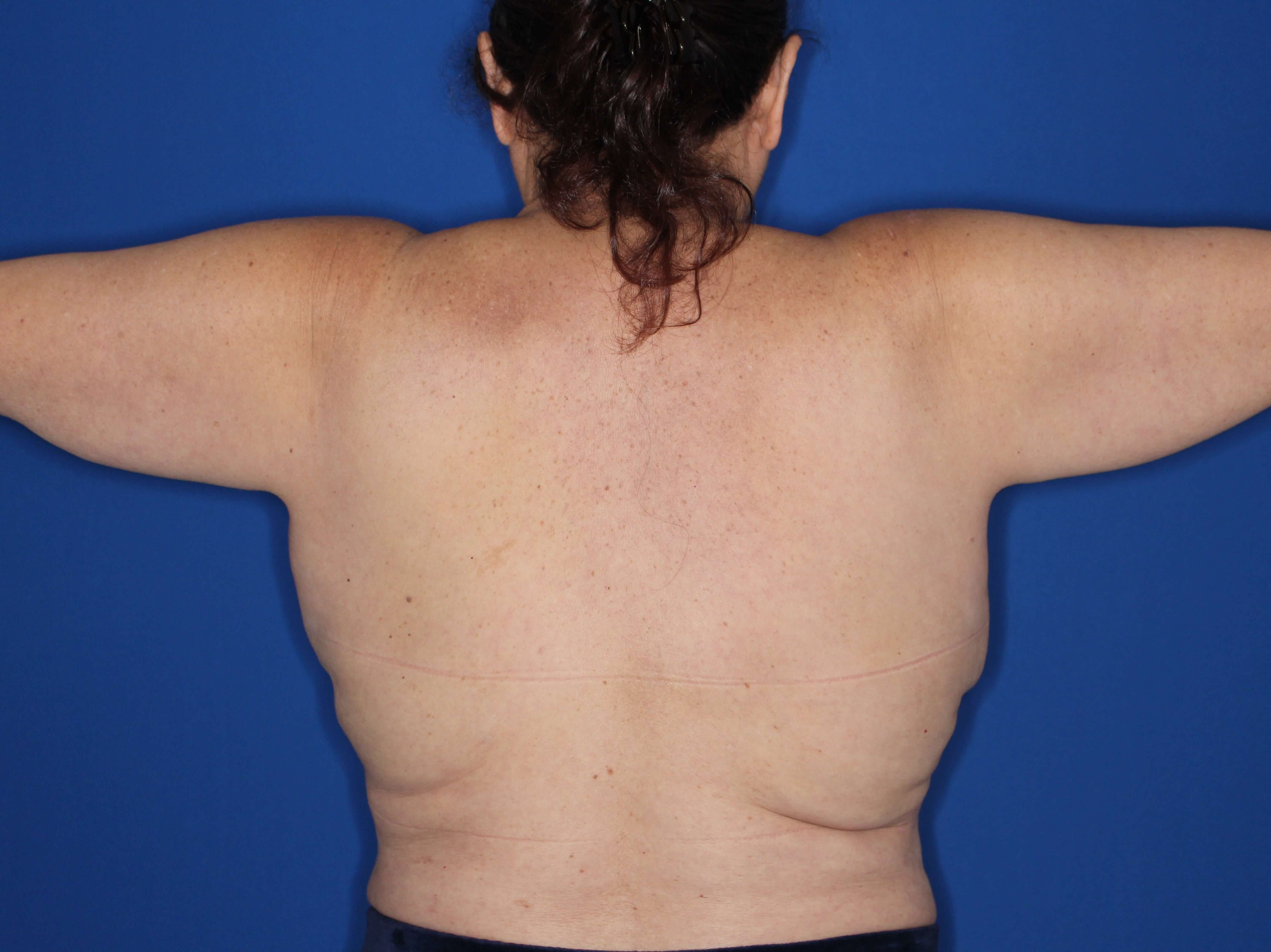 Liposuction of arms and back Before