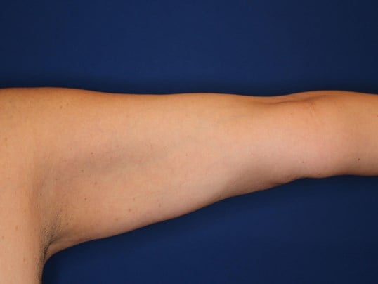 Liposuction Arms After