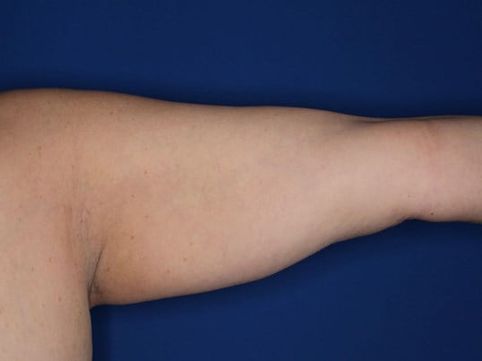 Liposuction Arms Before