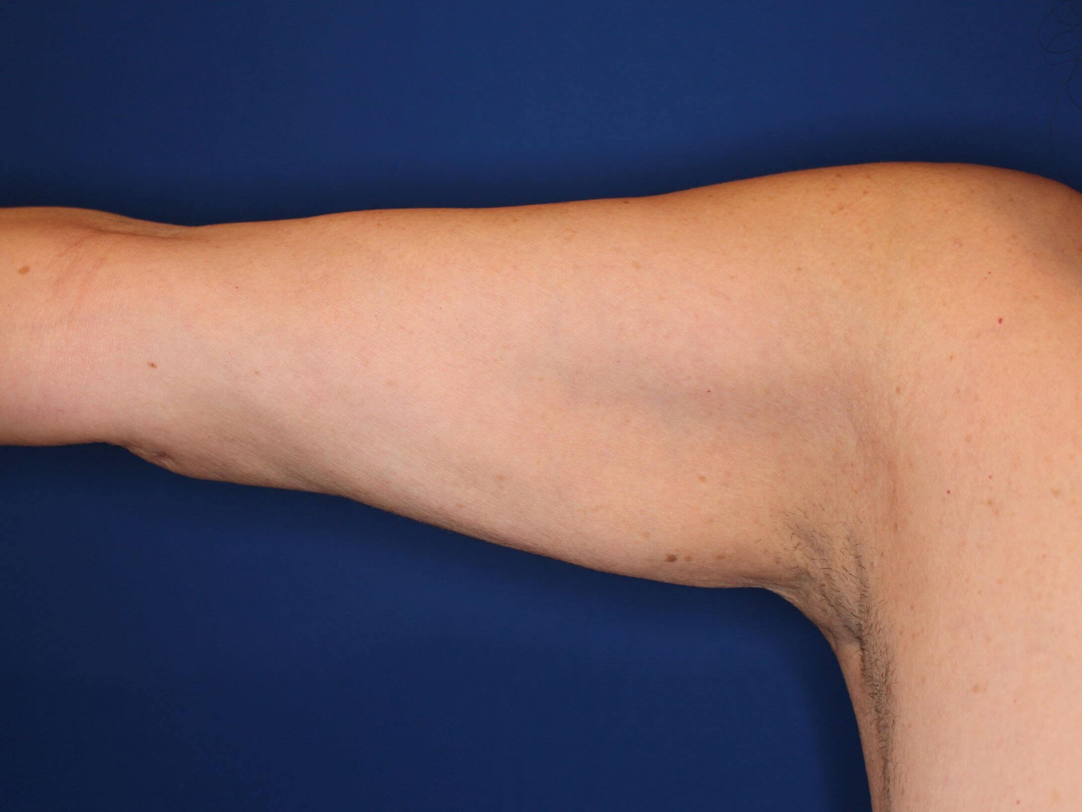 Liposuction Arms After