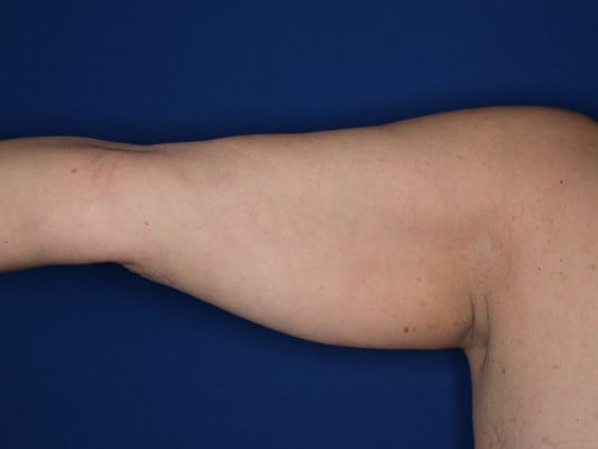 Liposuction Arms Before