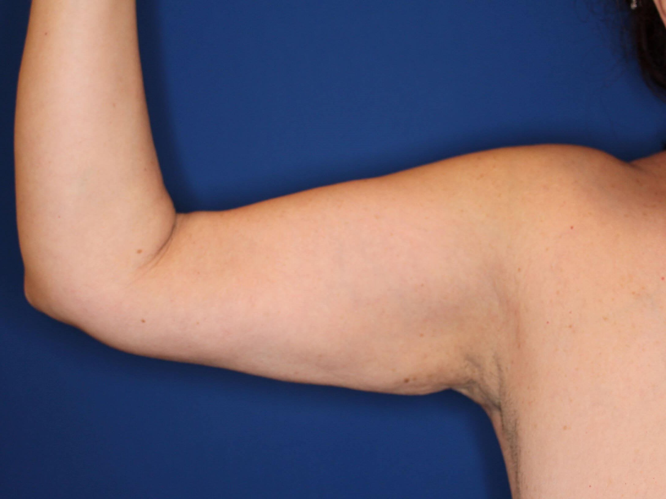Liposuction Arms After