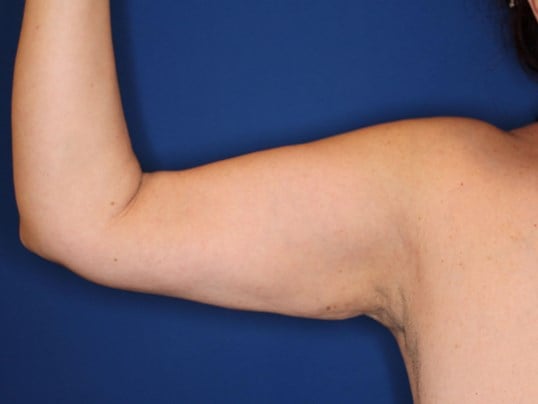Liposuction Arms After