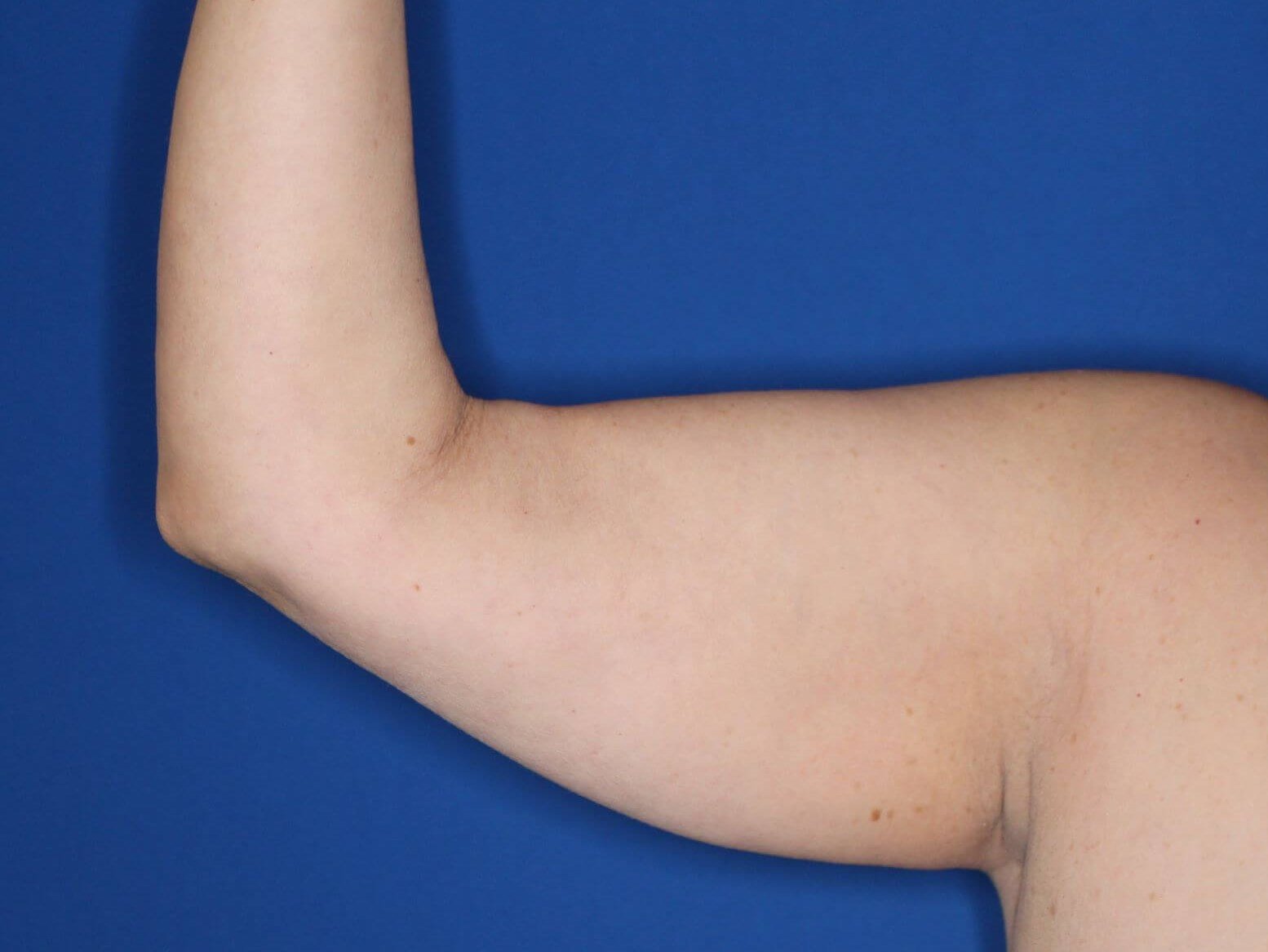 Liposuction Arms Before