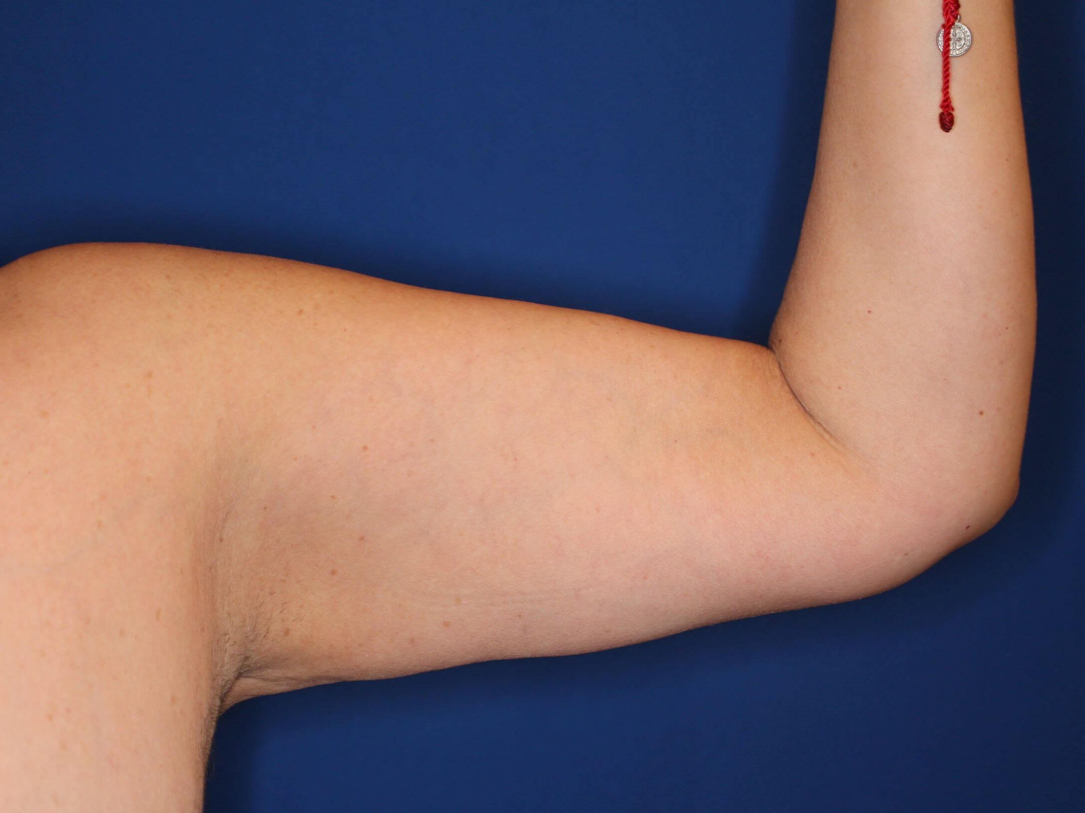 Liposuction Arms After