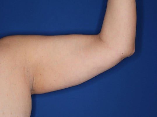 Liposuction Arms Before