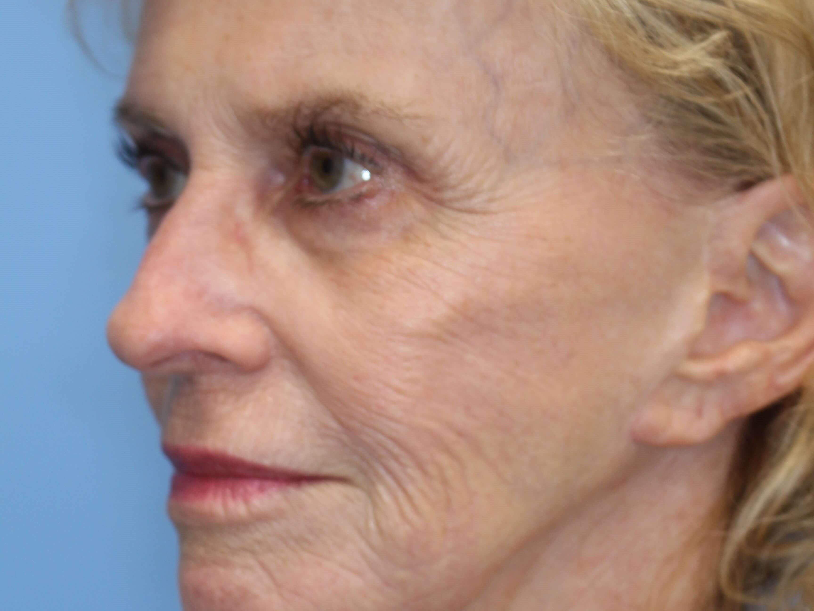 Fat Transfer to Face Before