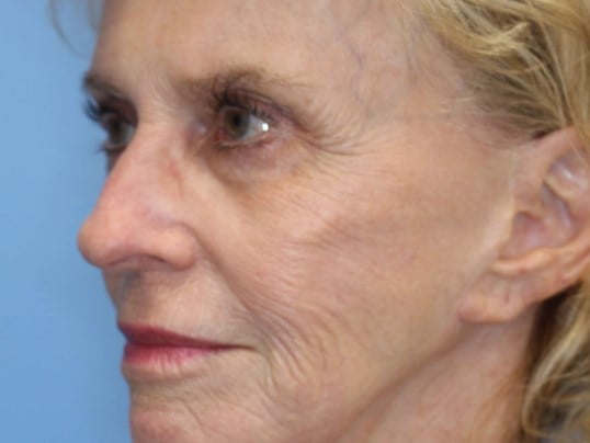 Fat Transfer to Face Before