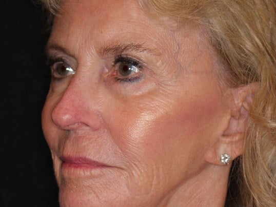 Fat Transfer to Face After