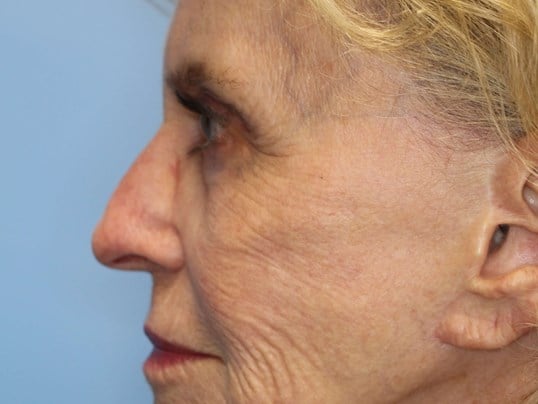 Fat Transfer to Face Before