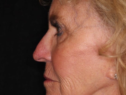 Fat Transfer to Face After