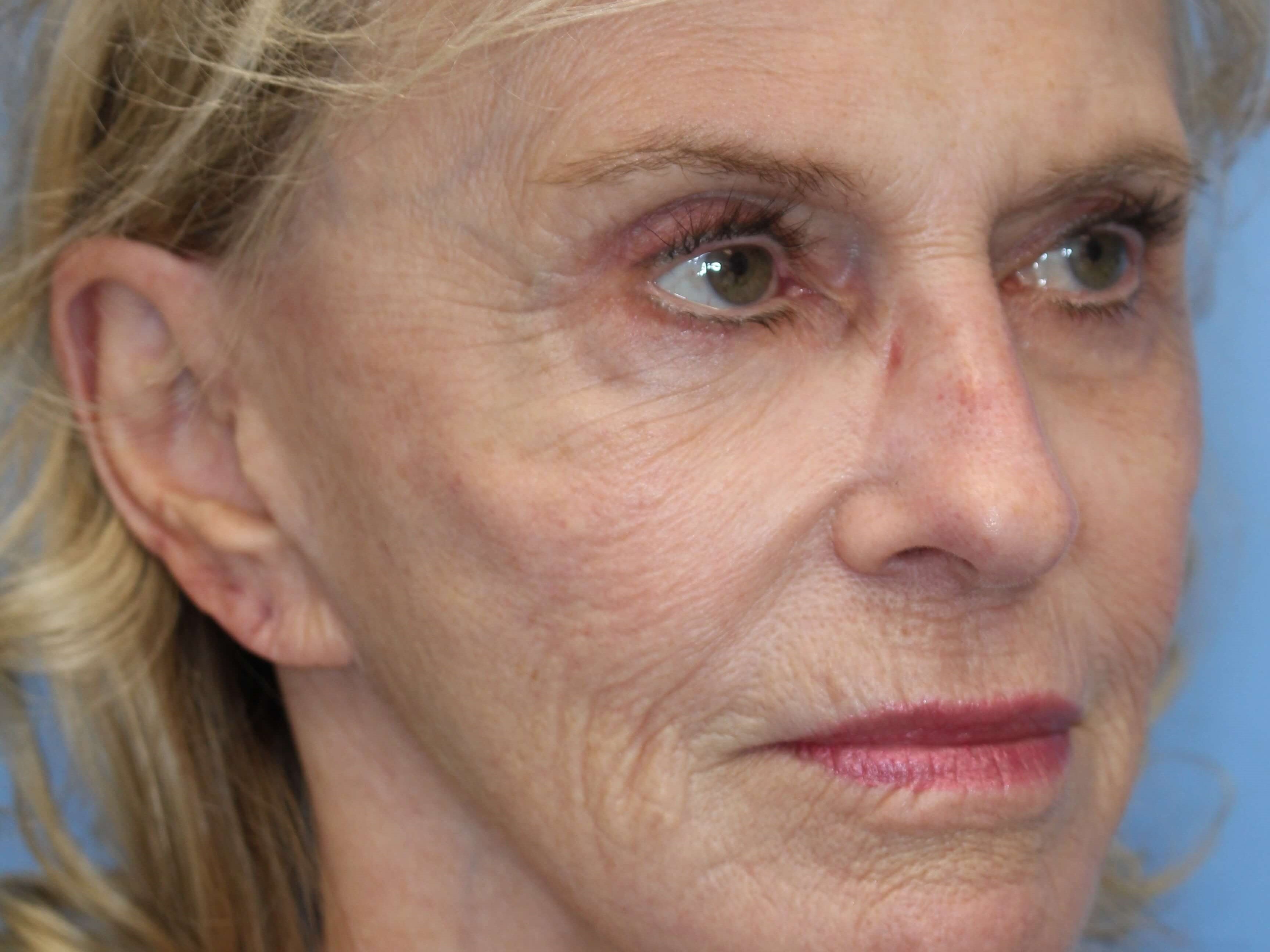 Fat Transfer to Face Before