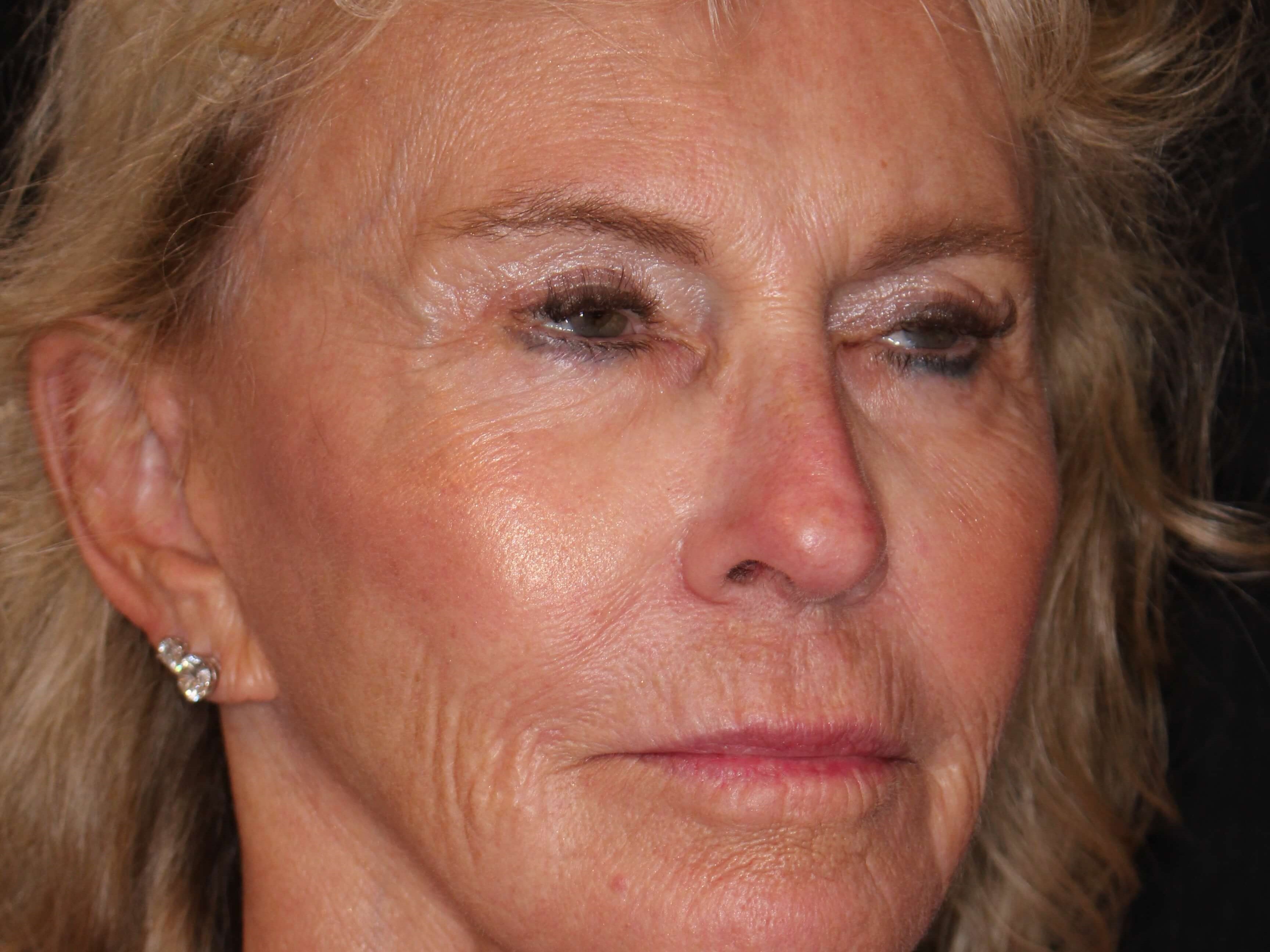 Fat Transfer to Face After