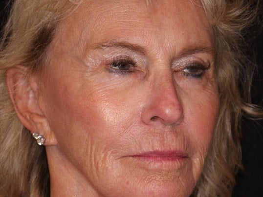 Fat Transfer to Face After