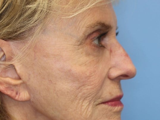 Fat Transfer to Face Before