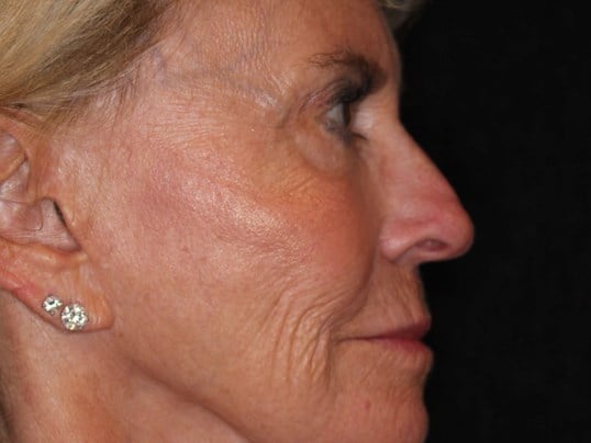 Fat Transfer to Face After