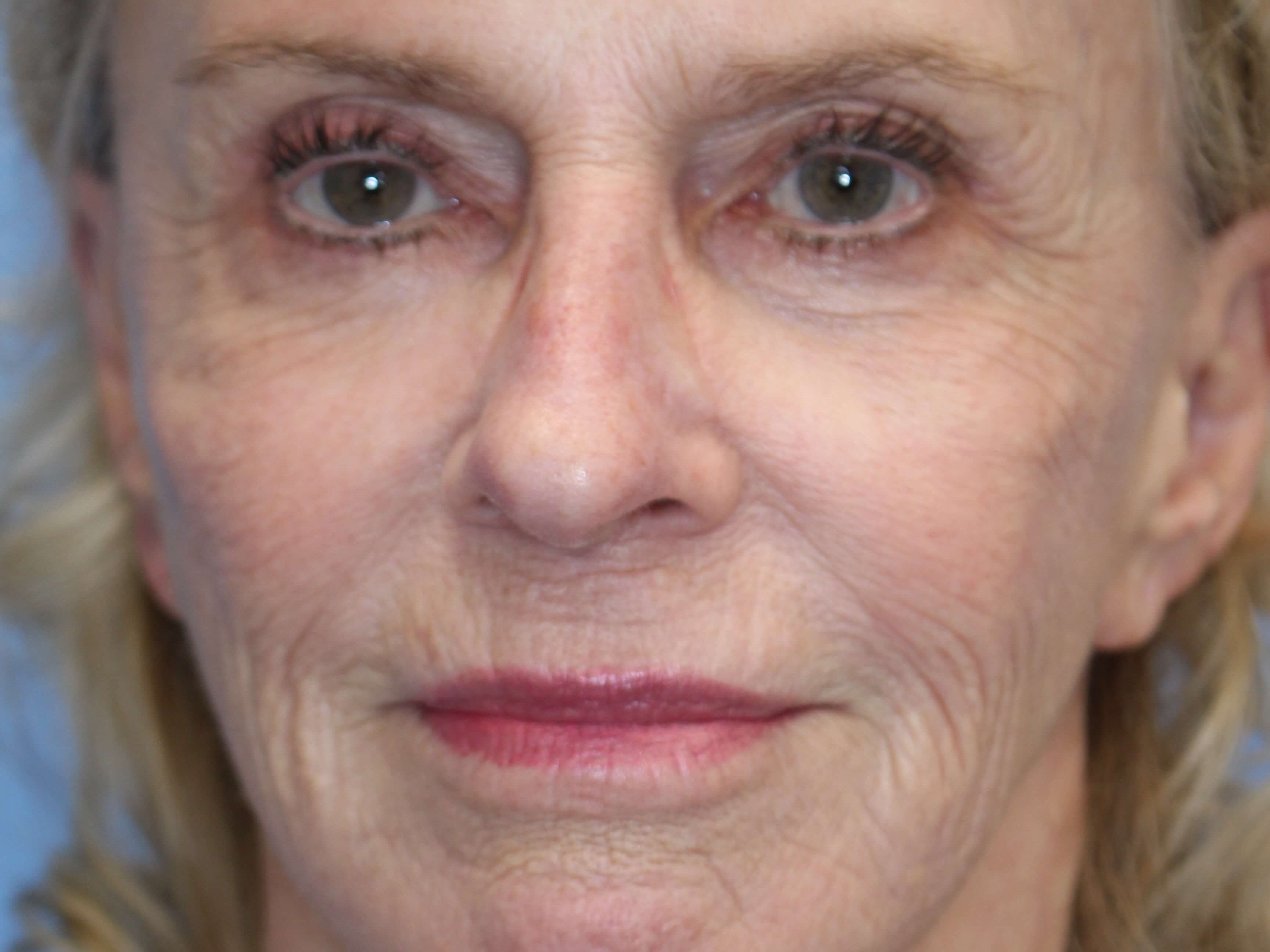 Fat Transfer to Face Before