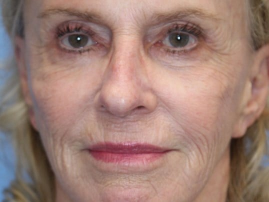 Fat Transfer to Face Before