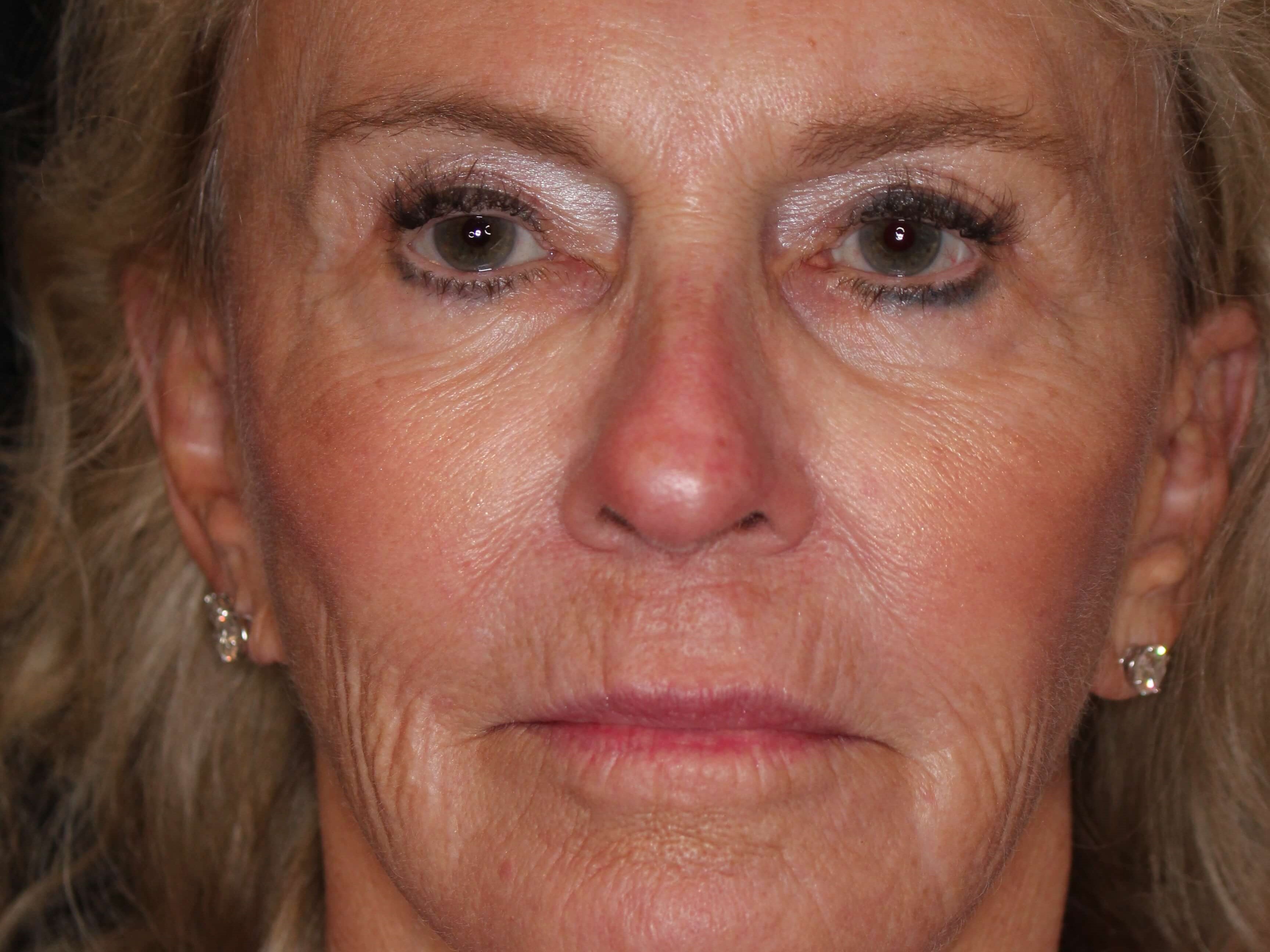 Fat Transfer to Face After