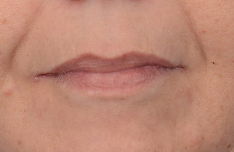 Fat Injection to Lip Before