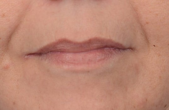 Fat Injection to Lip Before